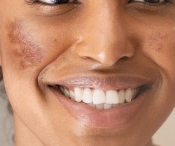 melasma